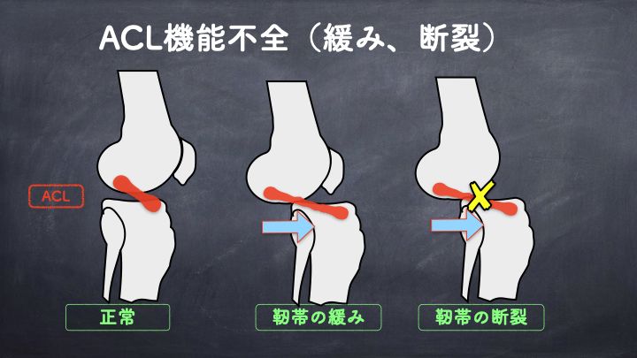 前十字靭帯　